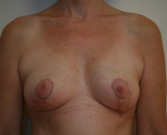 Feel Beautiful - Breast Reduction San Diego 12 - After Photo
